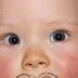 Pseudostrabismus Pictures, Test, Symptoms, Causes, Treatment - Health ...
