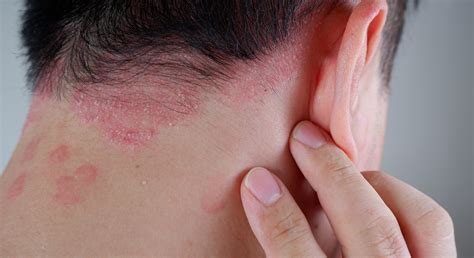 Dr.med.univ Michael Skoll - Schuppenflechte (Psoriasis) | Hautarzt in