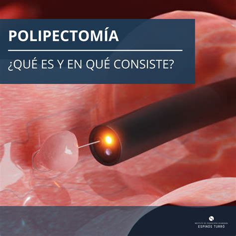 O Que É Polipectomia De Colon - Polipectomía endoscópica y sus beneficios para el colon | La Opinión