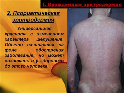 Эритродермии (эксфолиативный дерматит) - презентация онлайн