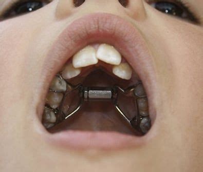 Palate Expander La Habra Dentist - Irwin Dentistry in La Habra