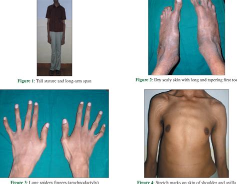 Unveiling the Complexities of Marfan Syndrome: A Comprehensive Overview ...