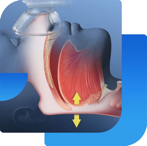 Obesity Hypoventilation Syndrome | Dr. Vinit Niranjane