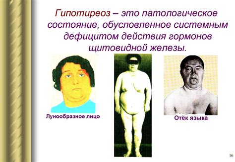 Патология щитовидной железы, паращитовидных желёз - презентация онлайн