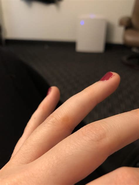 Blister on ring finger!?! Help : r/weddingplanning