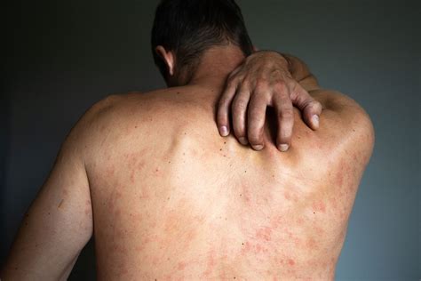 Skin Rash - RapidCare Emergency Room - Safe, Fast & Open 24/7 - Free