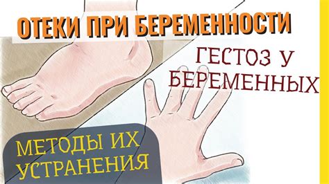 Причины появления отеков при беременности и способы устранения отеков ...