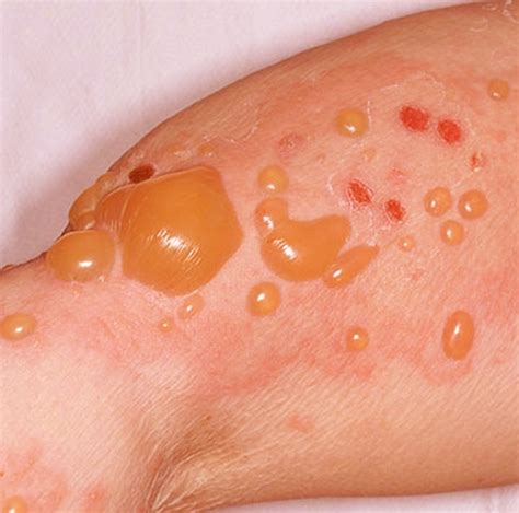 localized bullous pemphigoid bullous pemphigoid treatment icdk
