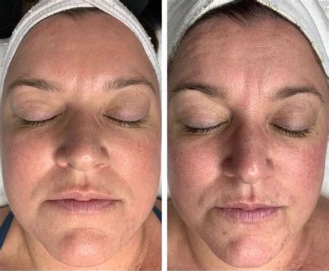 Procell Therapies Microchanneling | Therapy, Before after photo, Treatment