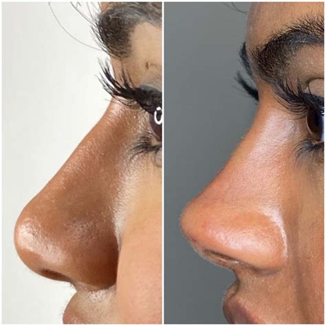 nose thread lift  erminia heavner blog