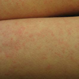 Lupus and Hives: Causes, Symptoms, and Treatment