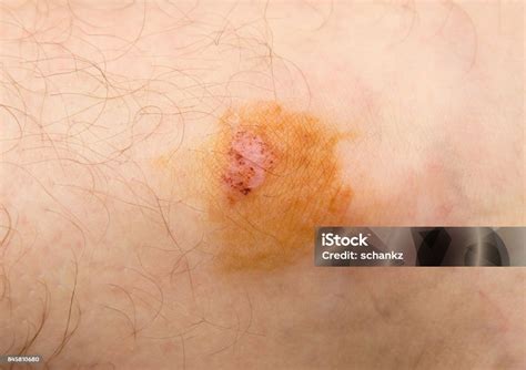Ringworm Of The Skin Macro Stock Photo - Download Image Now - Animal ...
