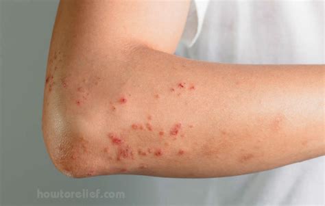 What Is Hives (Urticaria) | Symptoms, Causes,Treatment & Drugs » How To ...