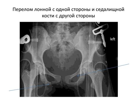 Повреждения таза и тазовых органов - презентация онлайн