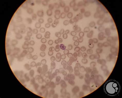 schizont plasmodium vivax