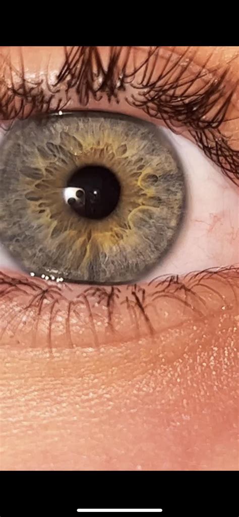 Hetrochromia