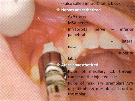 maxillary nerve blocks | PPT