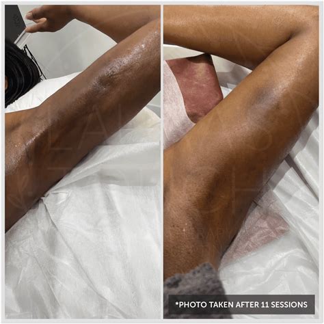 Understanding and Treating Post-Op Fibrosis After Cosmetic Fat Removal