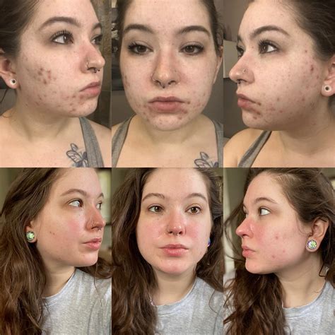 1 Month Hormonal Cystic Acne Treatment update : r/acne