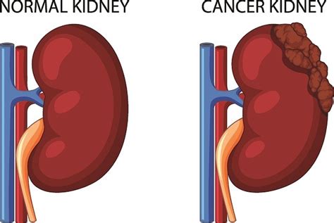 kanker ginjal gejala penyebab  mengobati alodokter