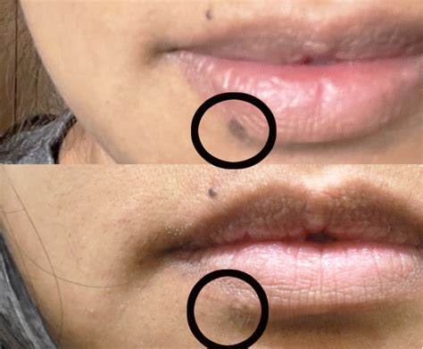 remove brown sun spots  lips naturally infoupdateorg