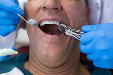 5 Reasons Why You May Need a Tooth Extraction - Gentle Care Dentistry 