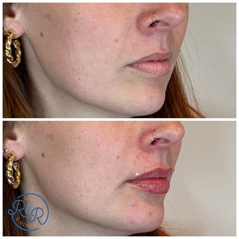 5 Things To Think About Before Getting Lip Fillers — Refresh & Renew MedSpa