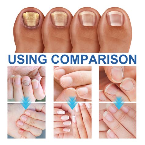 Antibacterial Cream Anti Fungal Cream Nail Fungus Treatment Plus