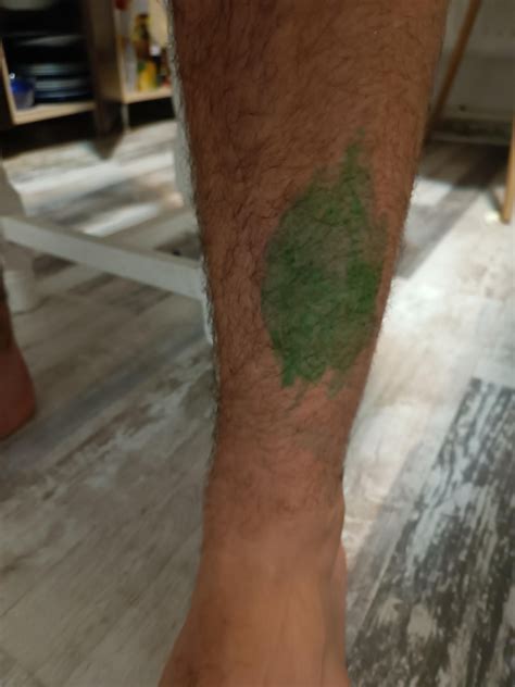 Chronic pain to knee and ankle : r/Orthopedics