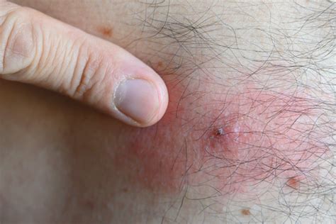 Tick Bite Pictures & Symptoms - What Does a Tick Bite Look Like?