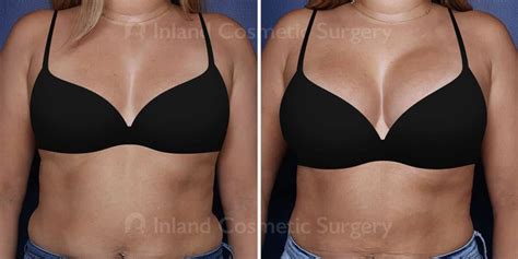 Breast Augmentation in Rancho Cucamonga | Inland Cosmetic Surgery