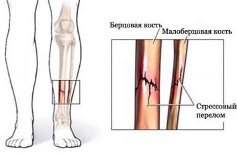Перелом малой берцовой кости: виды, симптомы и лечение