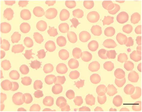 acanthocytes peripheral blood smear showing acanthocytosis