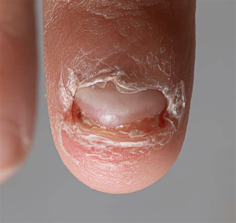 Nail Disorders | Devonshire Dermatology | London