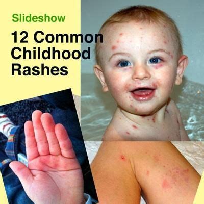 Slideshow: 12 Common Childhood Rashes | The Survival Doctor | Kids ...