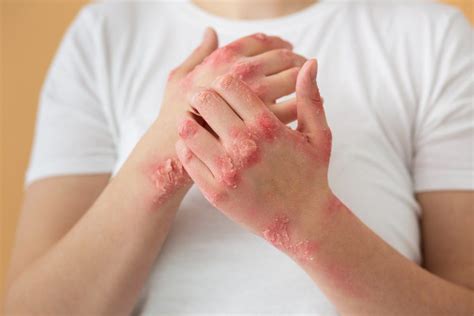 Eczema Ayurvedic Treatment - jane foster - Medium