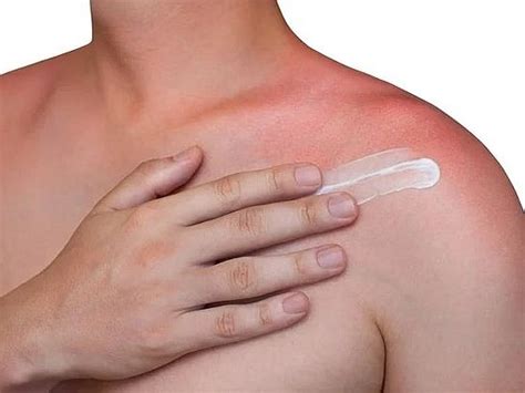 Alergia al sol