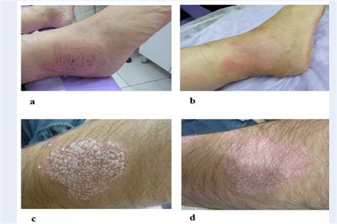 Evaluation of the efficacy of a topical chamomile-pumpkin oleogel for ...