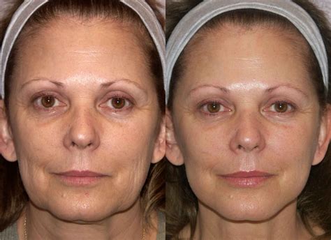 mini face lift mini lift face lift mini face lift face lift
