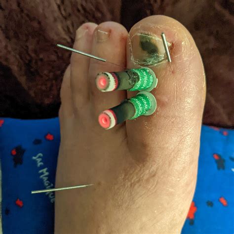 Traditional Chinese Medicine Case Report: Broken Big Toe — Alina Rehkopf