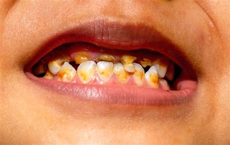 Dente De Criança Sujo - Dentes Podres Papo De Criança Para Criança: Como Não Ter Dentes