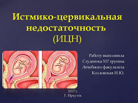 Истмико-цервикальная недостаточность (ИЦН) - презентация онлайн