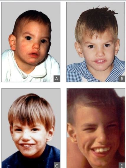 ТЕМА 15. ХРОМОСОМНІ ХВОРОБИ ЛЮДИНИ - BiologyBiology