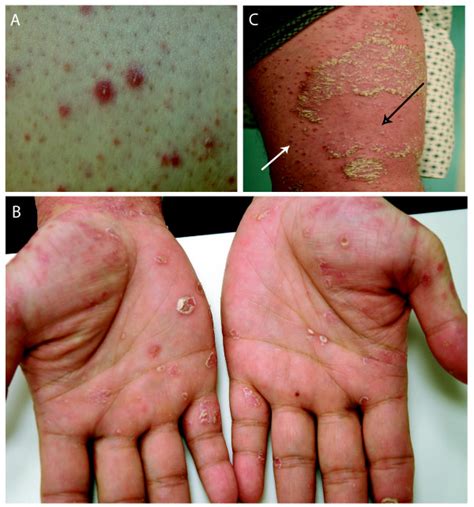 clinical photographs   patients  papular lesions