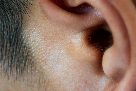 Earwax Removal Seattle at James Elliot blog