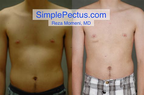 Simple_Pectus_Excavatum_Repair_case01ws — SIMPLE Pectus Excavatum Repair