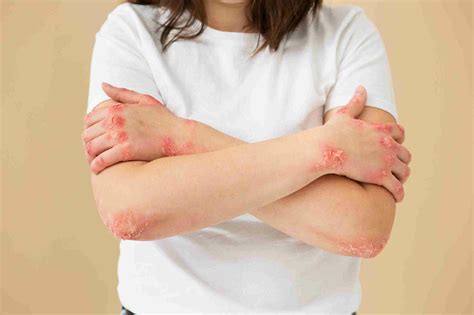 impetigo gejala penyebab pengobatan  pencegahan