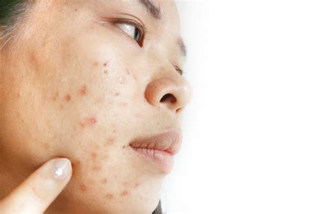 fight acne scars  infini laser  singapore ezra clinic