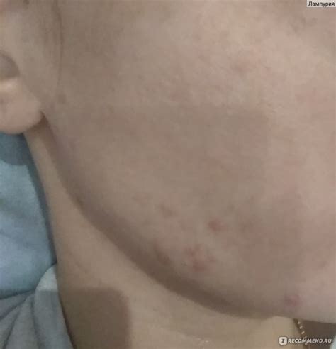Сыворотка для лица LEFAMI Acne Remover Serum для удаления акне - «Не ...