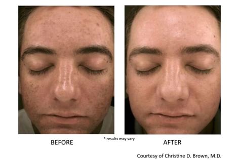 prp-facial-before-and-after-dallas - Amy A. Vaughan, M.D. Dermatology